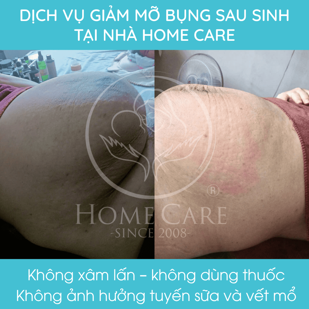 dich-vu-giam-mo-bung-giam-eo-sau-sinh-tai-nha-home-care2