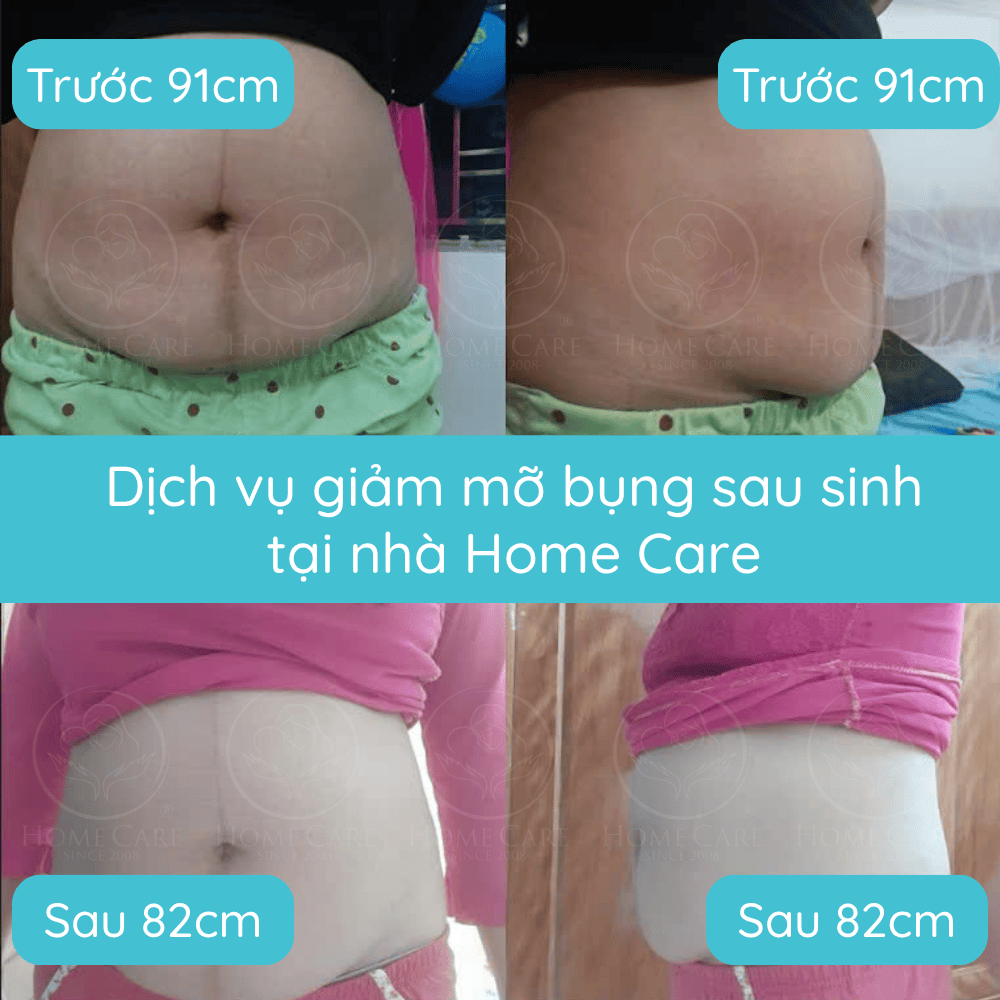 dich-vu-giam-mo-bung-giam-eo-sau-sinh-tai-nha-home-care3