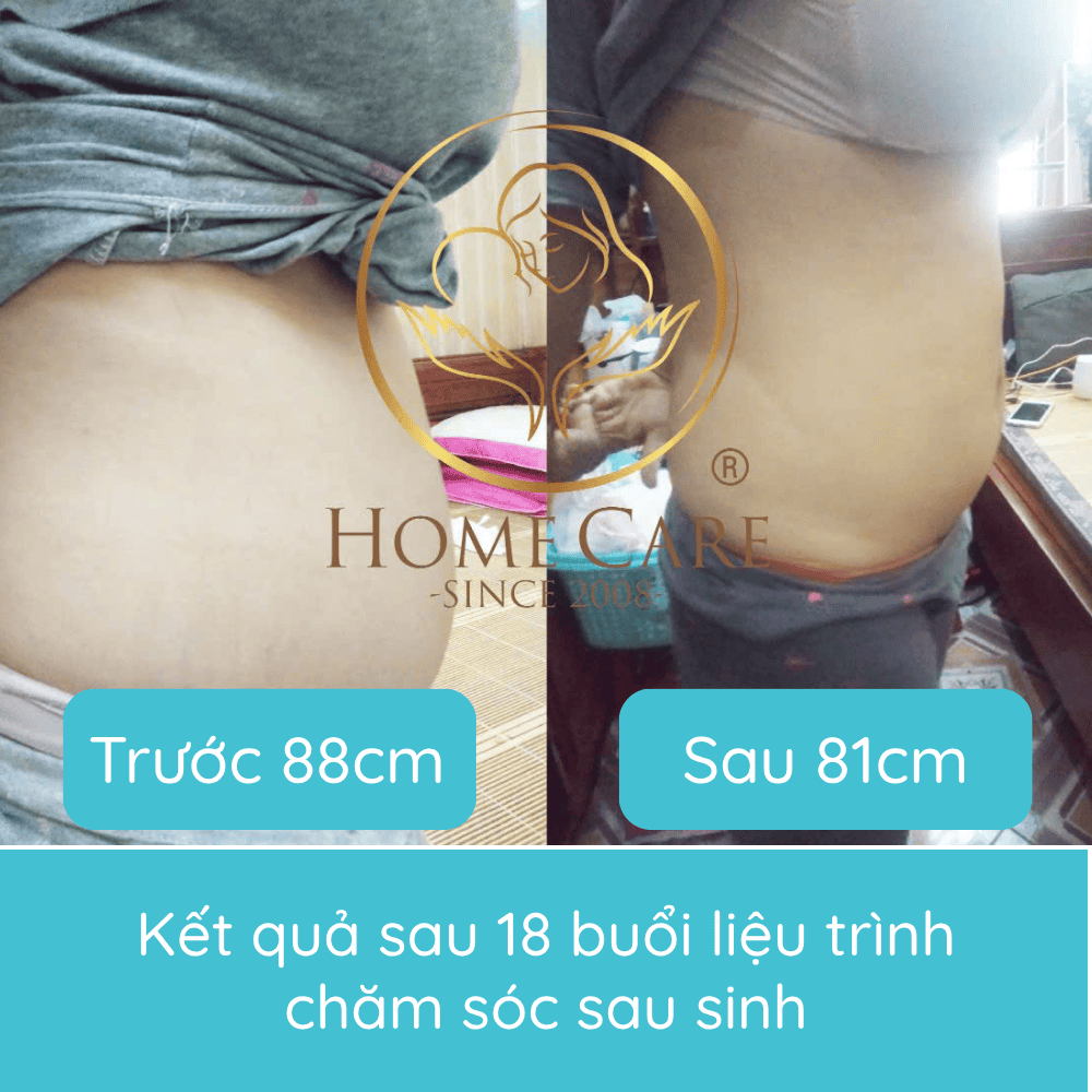 dich-vu-giam-mo-bung-giam-eo-sau-sinh-tai-nha-home-care4