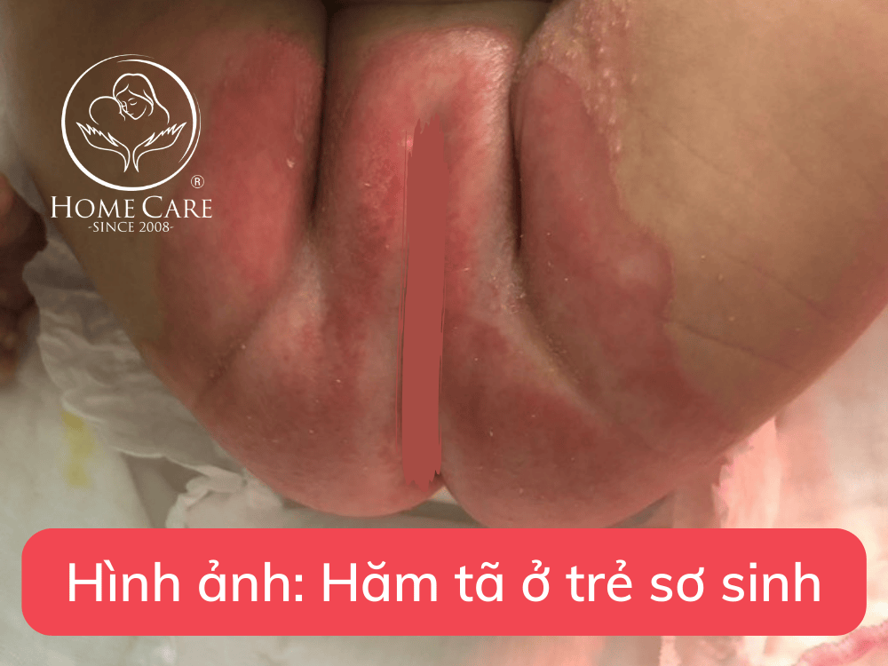 ham-ta-tre-so-sinh