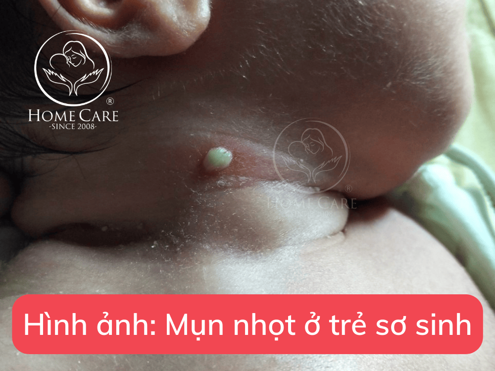 mun-nhot-tre-so-sinh