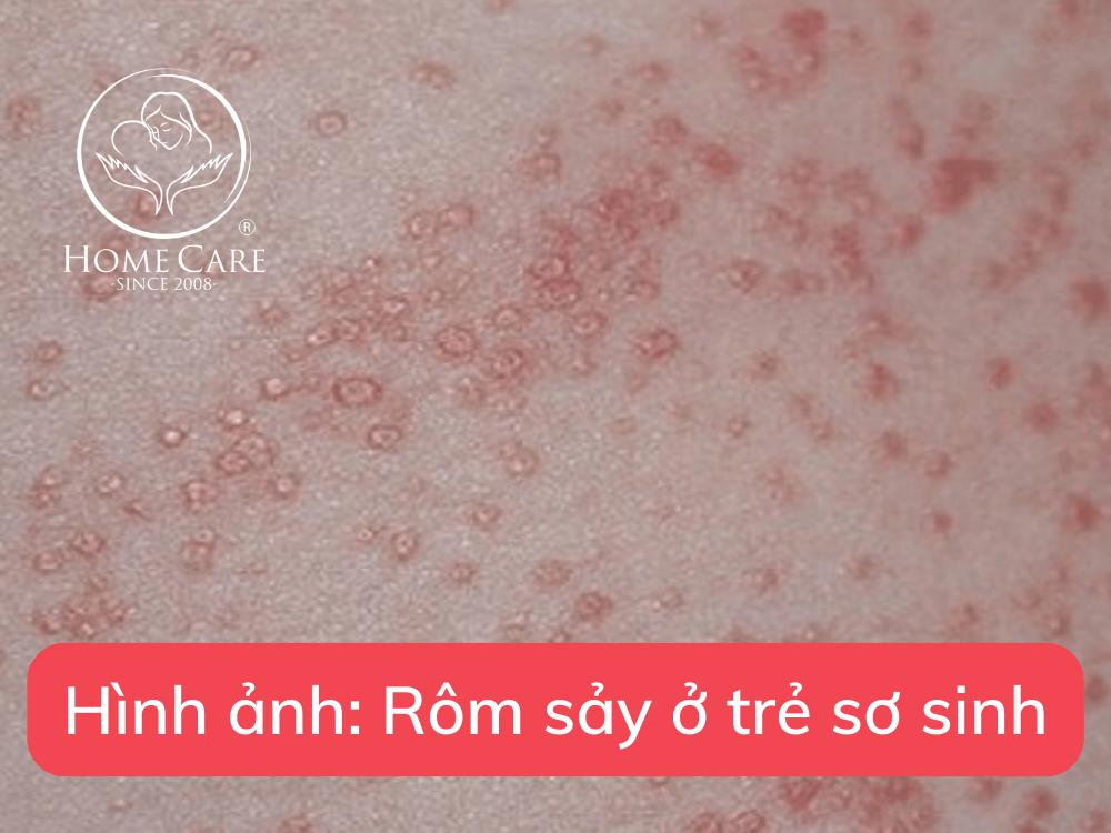 rom-say-tre-so-sinh