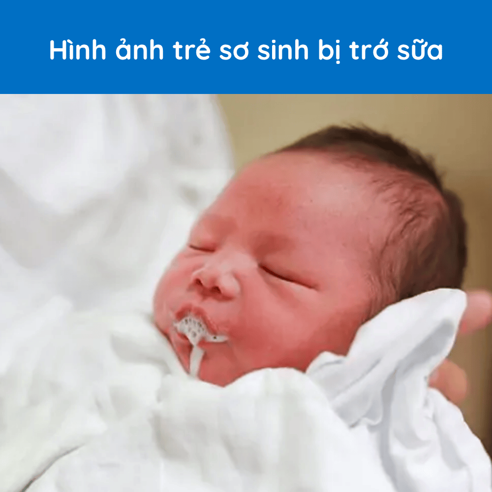 hinh-anh-tre-so-sinh-bi-tro-sua
