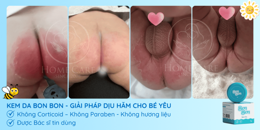 KEM DA BON BON - GIẢI PHÁP DỊU HĂM CHO BÉ YÊU
