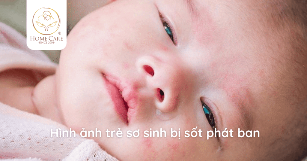 sot-phat-ban-o-tre-so-sinh-a2