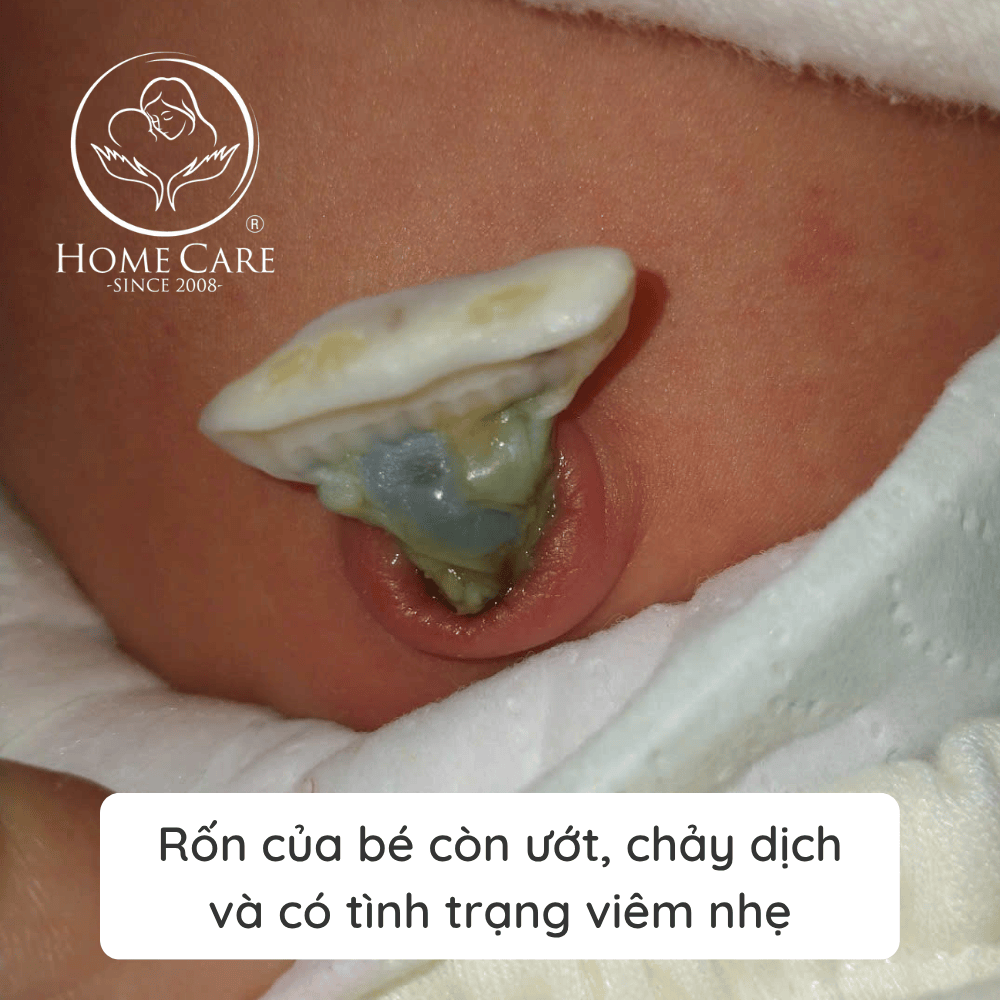 ron-be-so-sinh-bi-uot-chay-dich-viem-nhe