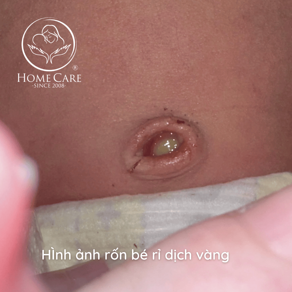 ron-tre-so-sinh-ri-dich-vang (2)