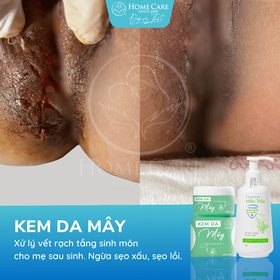 kem-cham-soc-vet-rach-tang-sinh-mon